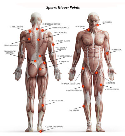 Treatment for Trigger Point Therapy - Guardian Medical